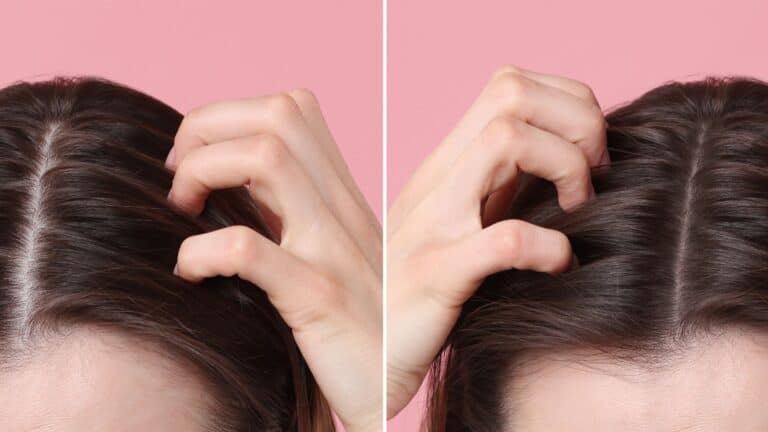 жена с косопад и лечение и възсановяване - растеж на коса